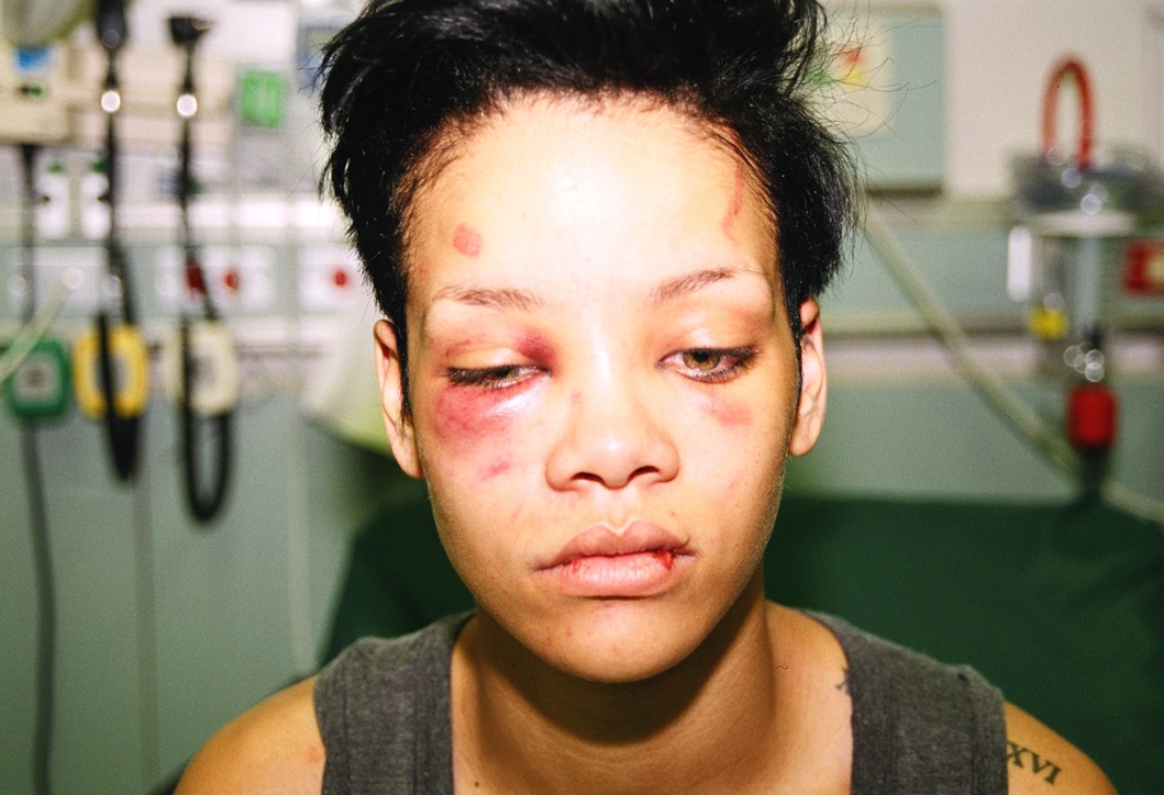 Rihanna battered face