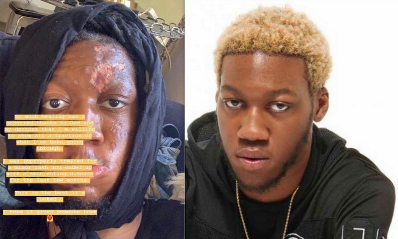 OG Maco disease