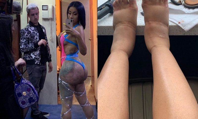 Cardi B plastic surgery