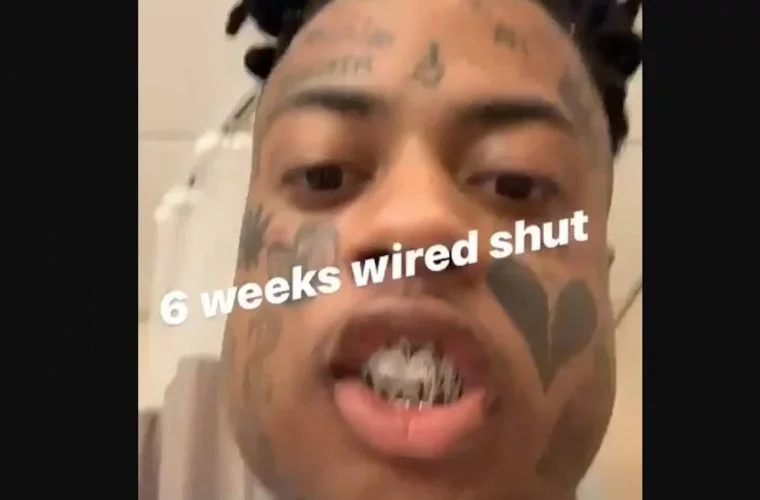 Boonk broken jaw