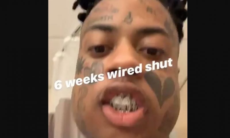 Boonk broken jaw